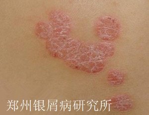 牛皮癣常识