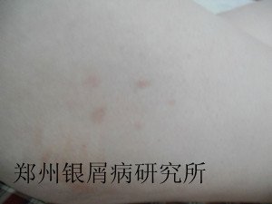 牛皮癣治疗