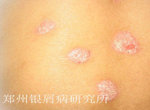 牛皮癣症状