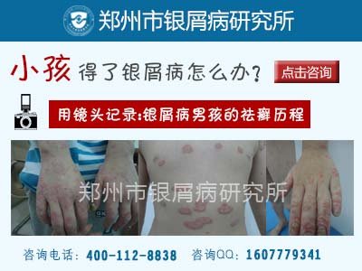 河南新乡专业治疗儿童牛皮癣的医院是哪家