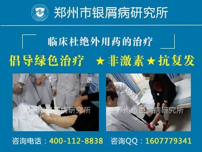 郑州市治疗牛皮癣哪家医院更权威