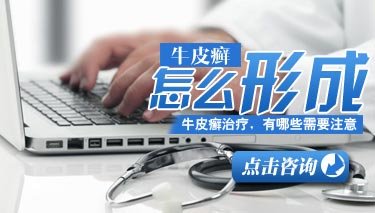 郑州市哪家医院治疗牛皮癣是最专业的